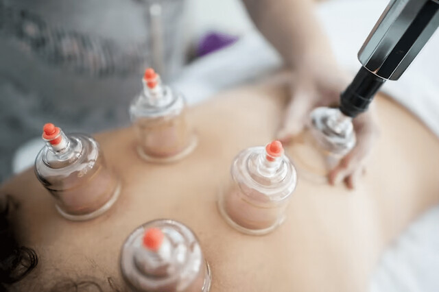 Séance de Cupping Therapy à Lyon